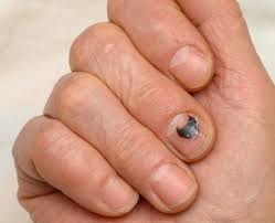 Hematoma under nail